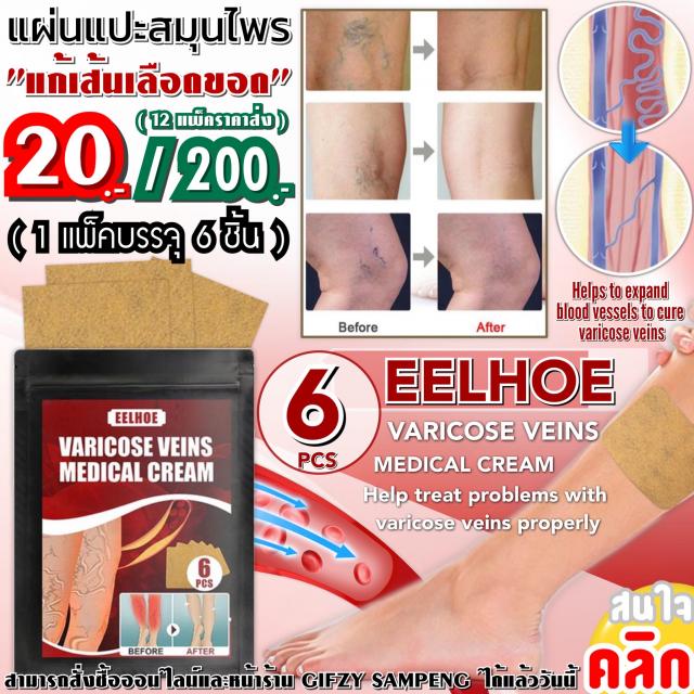Eelhoe varicose veins แผ่นแปะสมุนไพรแก้เส้นเลือดขอด 12 ซองราคาส่ง 200 บาท