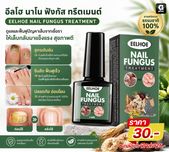 EELHOE NAIL FUNGUS TREATMENT อีลโฮนาโนฟังกัสทรีตเม